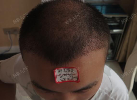 郑州欧兰植发头顶加密种植第21天美丽日记-新