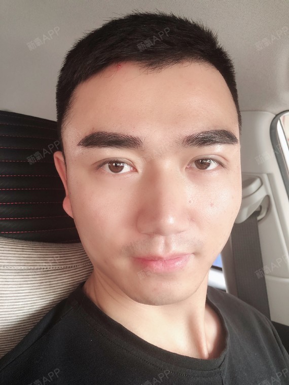 雁声如泣定点双眼皮第3天美丽日记-新氧美容整