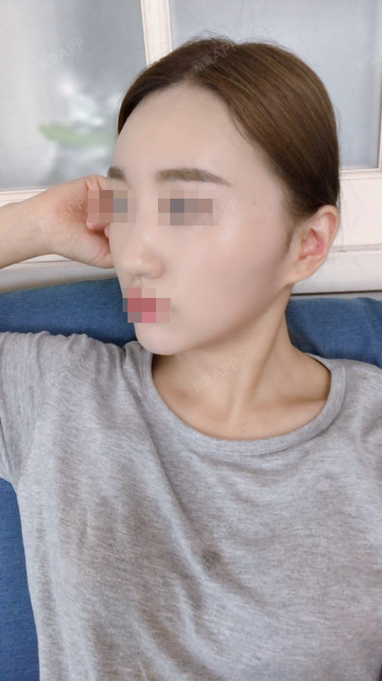 杨小敏颧骨内推第91天美丽日记-新氧美容整形