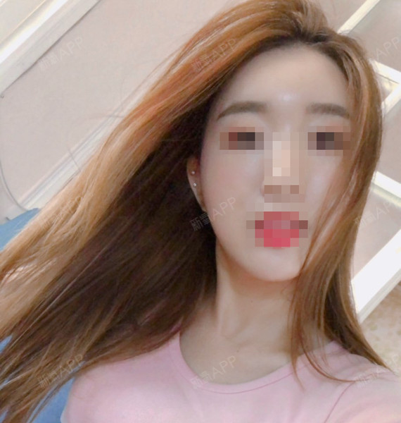 杨小敏颧骨内推第91天美丽日记-新氧美容整形