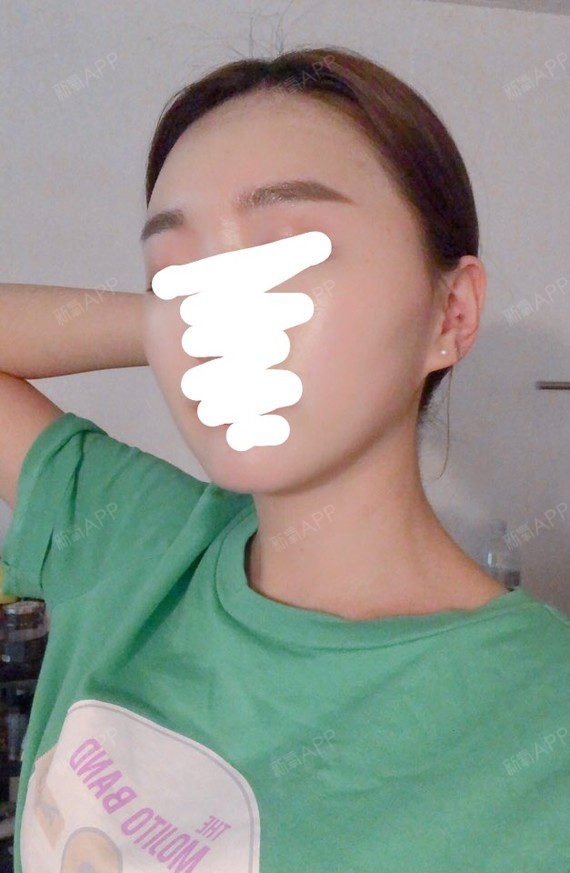 杨小敏颧骨内推第30天美丽日记-新氧美容整形