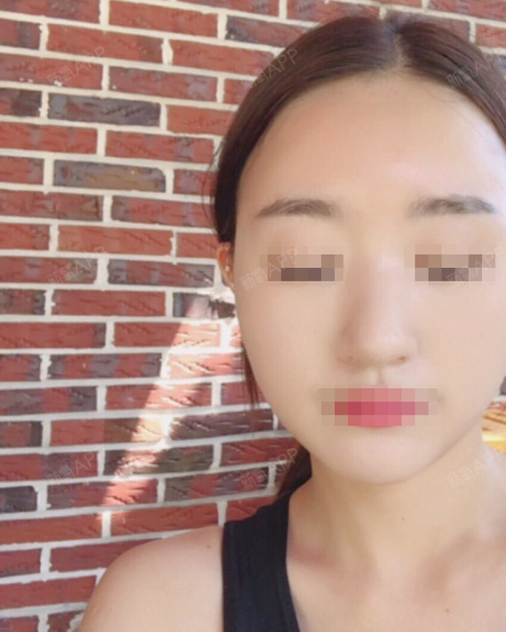 杨小敏颧骨内推第91天美丽日记-新氧美容整形