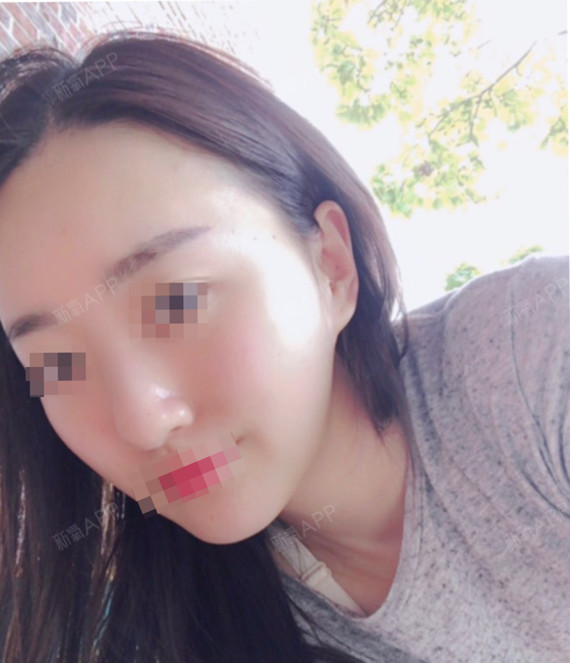 杨小敏颧骨内推第91天美丽日记-新氧美容整形