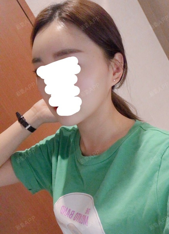 杨小敏颧骨内推第30天美丽日记-新氧美容整形