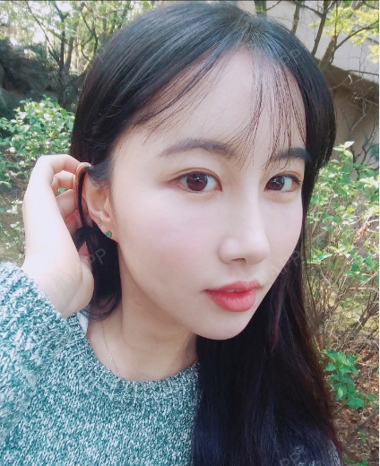 525139254鼻综合第33天美丽日记-新氧美容整形