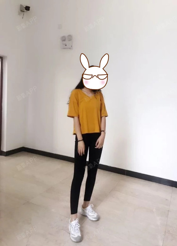 氧气9599431519984240肉毒素瘦小腿第18天