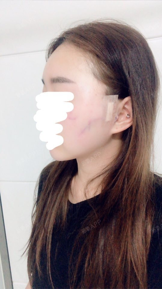 杨小敏颧骨内推第1天美丽日记-新氧美容整形