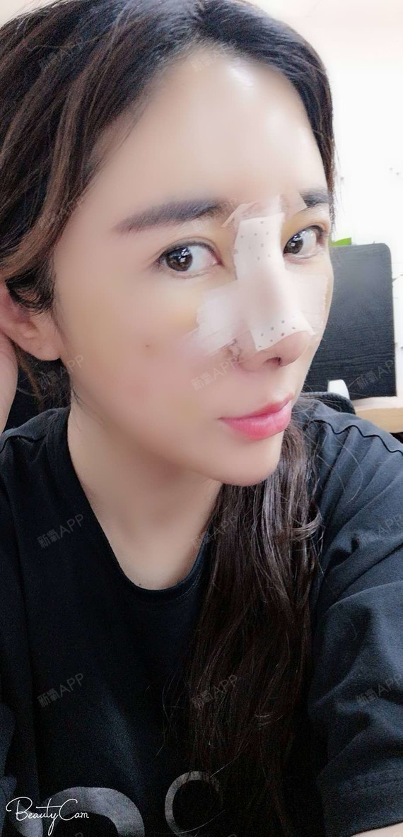 鼻部 隆鼻 术后当自强 北京同城 鼻部综合 肋软骨隆鼻