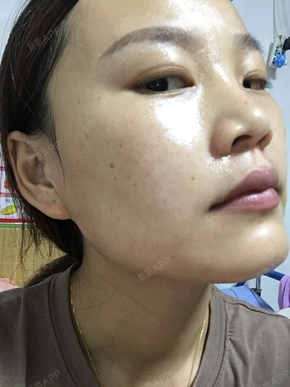 刚注射完水光补水那天,脸上有很多的细小可见的小针眼