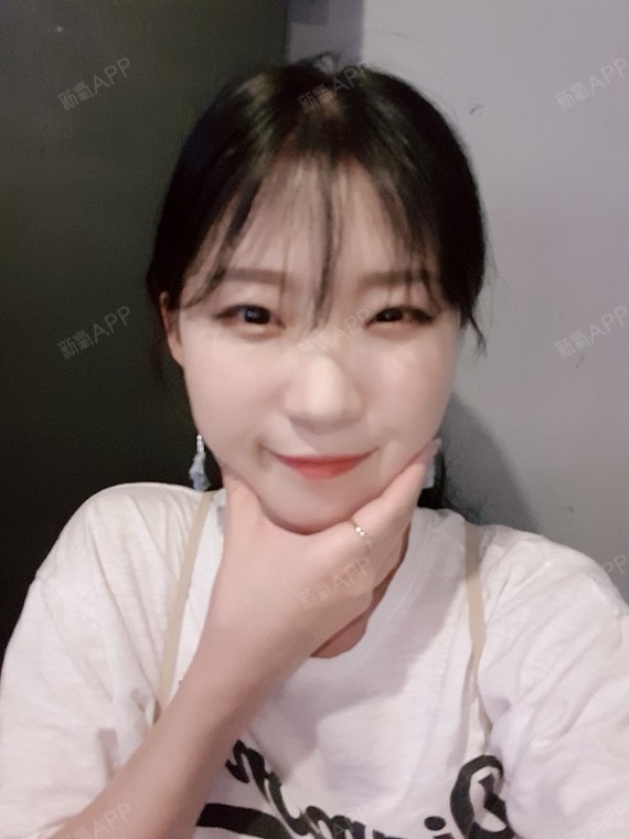 最值钱的还是脸颧骨颧弓整形术第199天美丽日