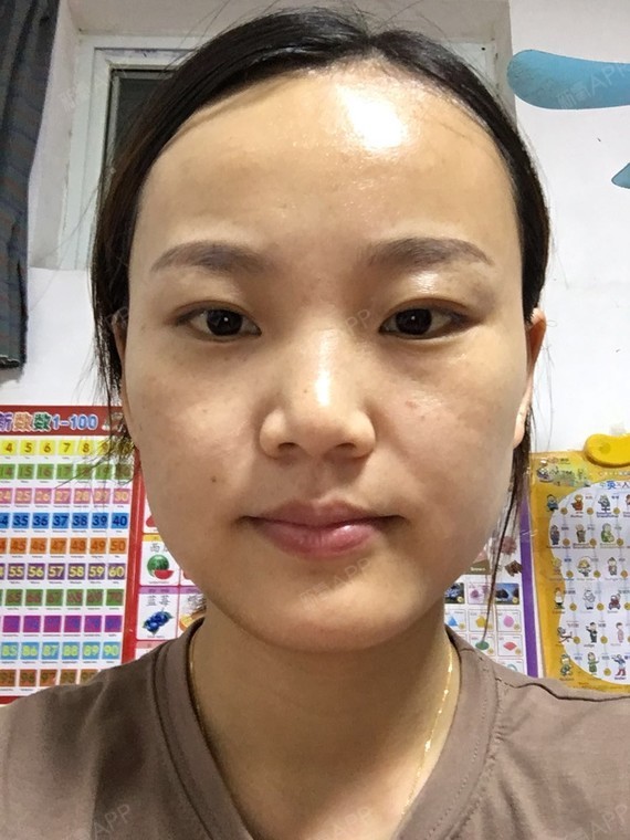 刚注射完水光补水那天,脸上有很多的细小可见的小针眼