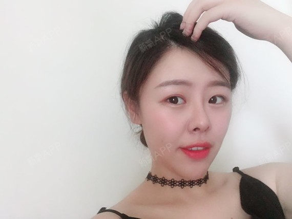 去吧皮卡皮卡丘耳软骨复合隆鼻第297天美丽日