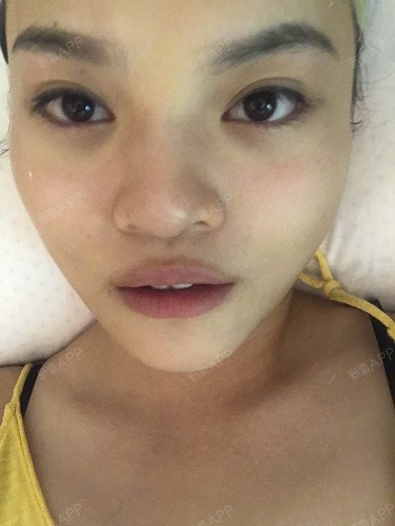 yo思思酱激光去眼袋第0天美丽日记-新氧美容整