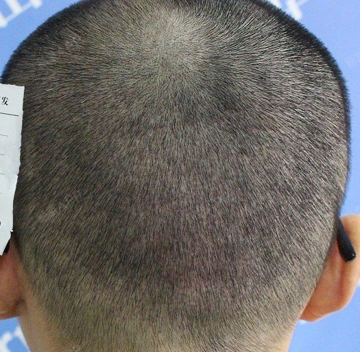 氧气x3c4u头顶加密种植第10天美丽日记-新氧美