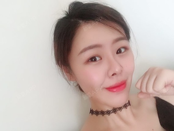 去吧皮卡皮卡丘耳软骨复合隆鼻第297天美丽日