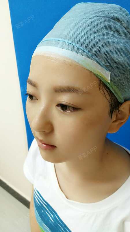 每天都想王嘉尔激光去眼袋第0天美丽日记-新氧