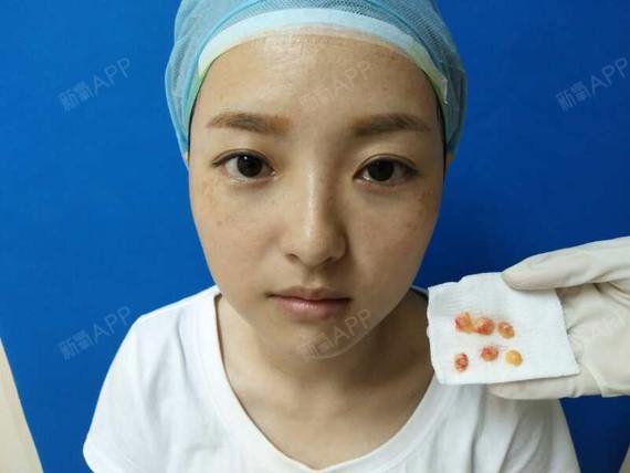 每天都想王嘉尔激光去眼袋第0天美丽日记-新氧