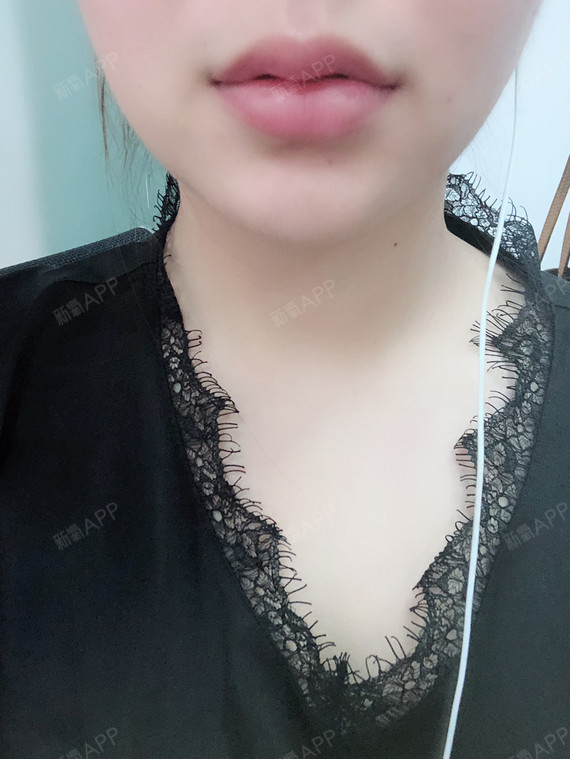 氧气x796c玻尿酸丰唇术后第7天美丽日记_新氧整形