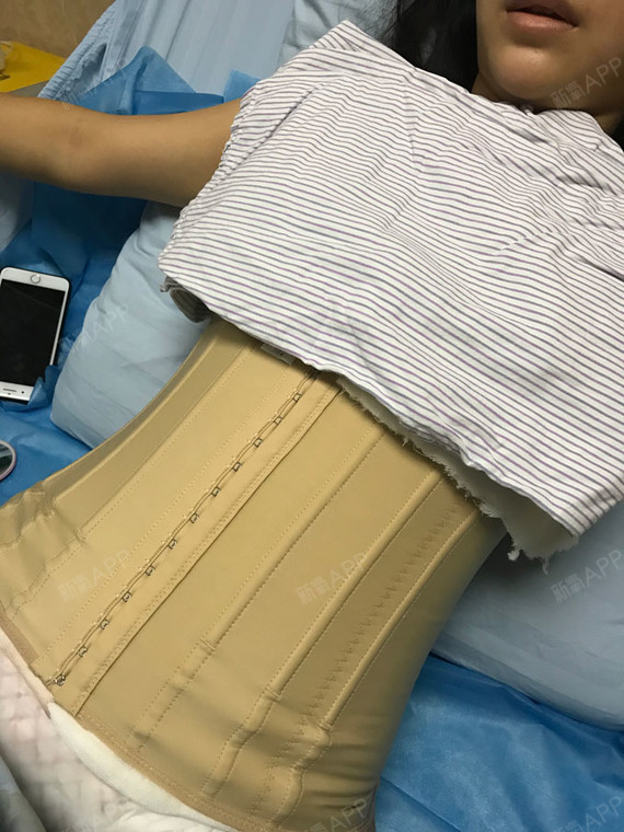 新氧- 33小仙女 | 美体塑形 | 吸脂瘦腹部 | 术后当自强 | 广州同城