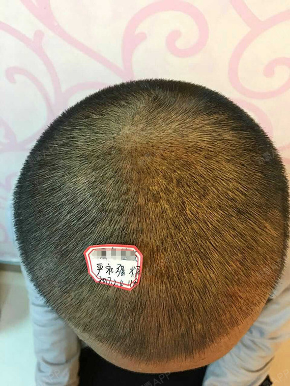 郑州欧兰植发头顶加密种植第14天美丽日记-新