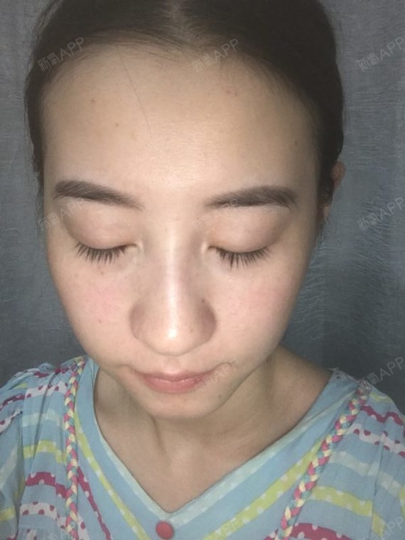 顽皮兜兜激光祛红血丝第26天美丽日记-新氧美