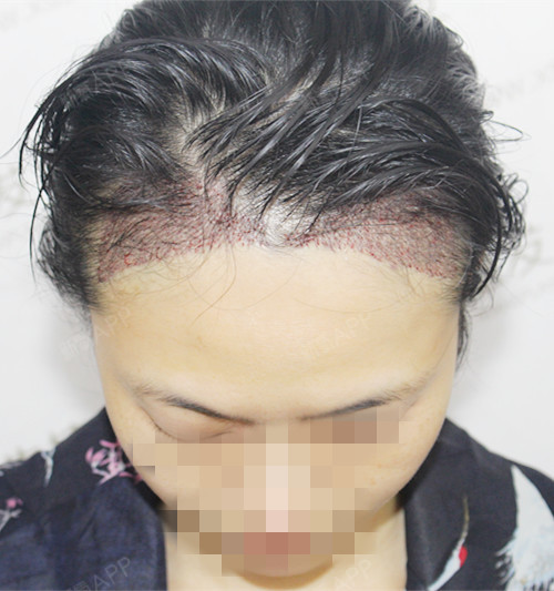 仙台种植发际线第0天美丽日记-新氧美容整形