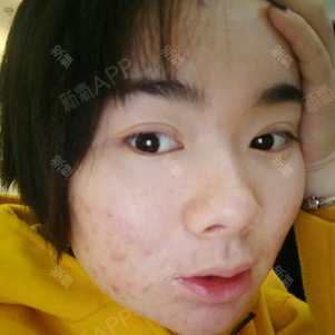 氧气xwa7i果酸焕肤第3天美丽日记-新氧美容整