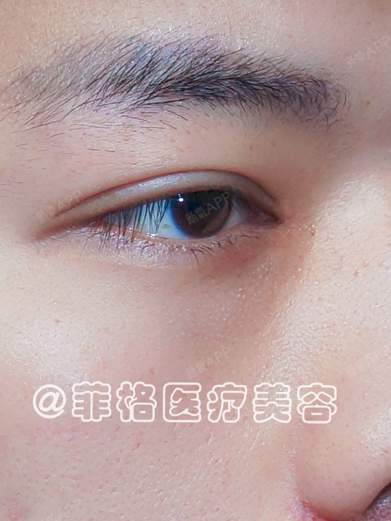 氧气0928661495968499定点双眼皮第76天美