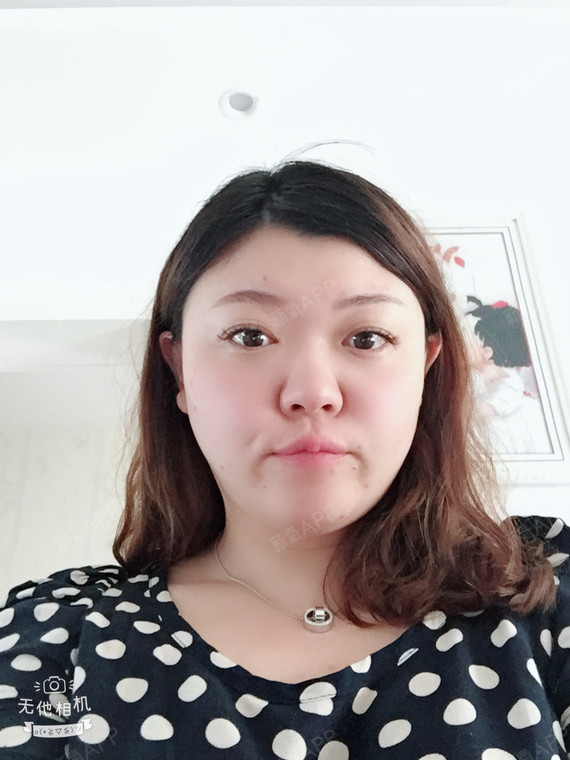 乔欣鑫面部吸脂第211天美丽日记-新氧美容整形