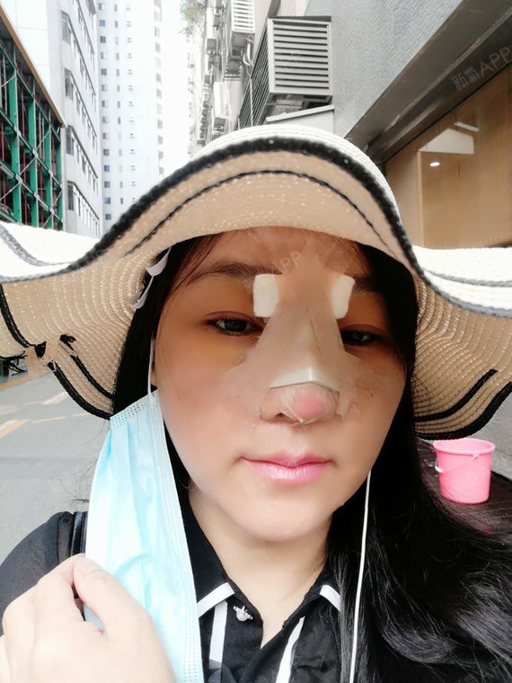 氧气xs981鼻综合第3天美丽日记-新氧美容整形