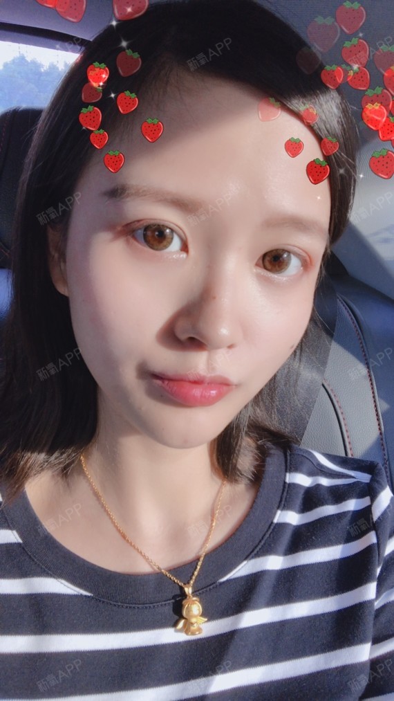 氧气1049601526138023埋线提升第50天美丽