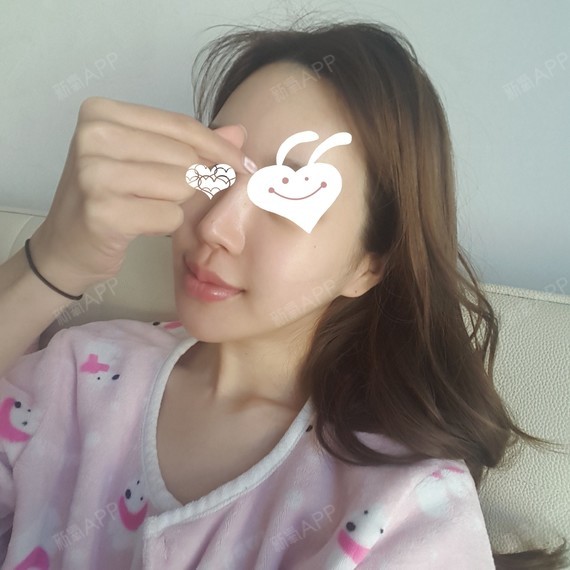 Sily苏暖年下颌角整形第27天美丽日记-新氧美容