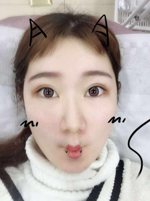 24732268埋线提升第43天美丽日记-新氧美容整形