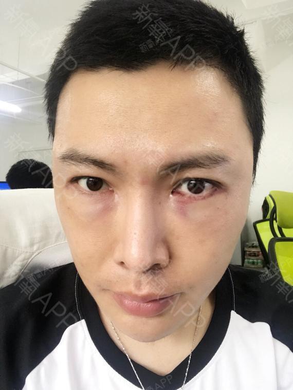 阳光下的我和你激光去眼袋第2天美丽日记-新氧