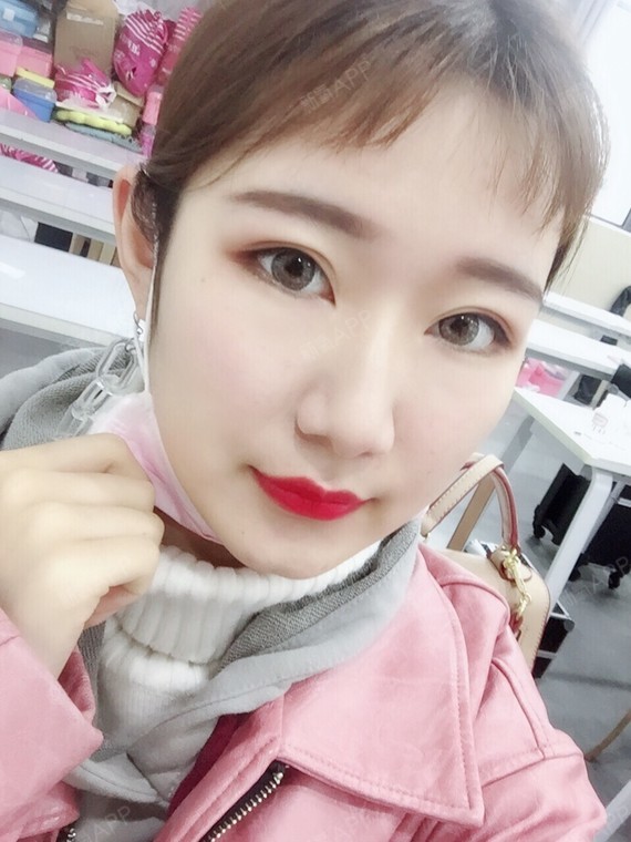 24732268埋线提升第43天美丽日记-新氧美容整形