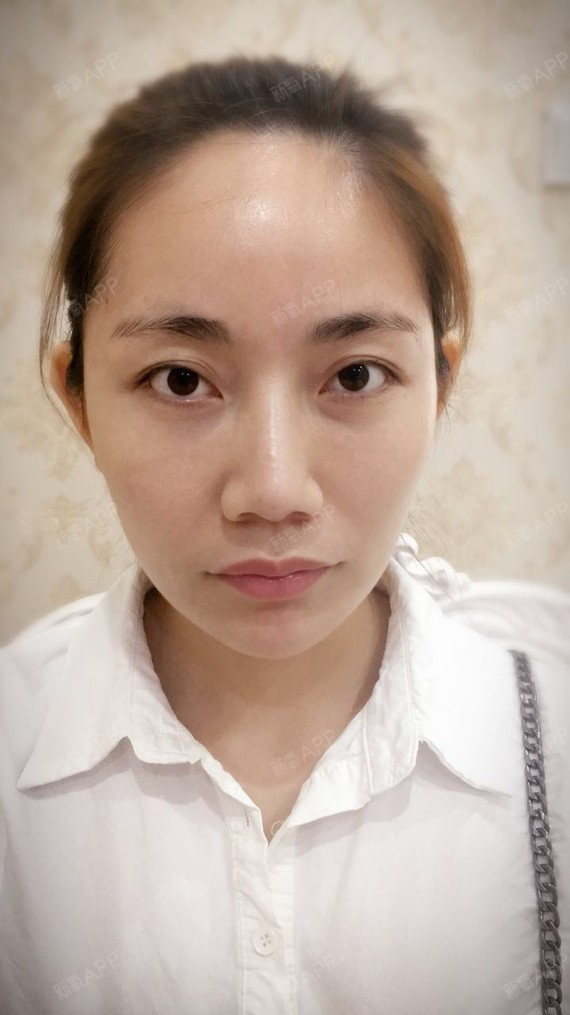 氧气7888401508743771定点双眼皮第0天美丽