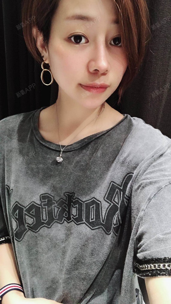 小蔓荷娜鼻综合第180天美丽日记-新氧美容整形