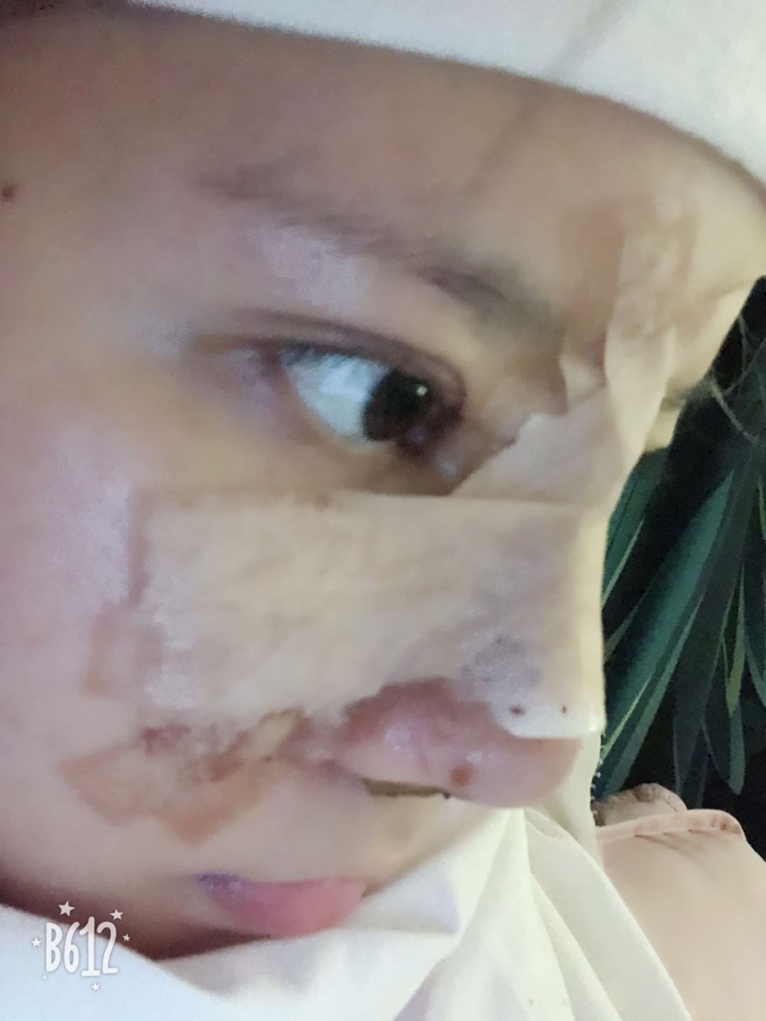 鼻综合怎么样_恢复过程_效果如何_天蝎座的风整形日记9.