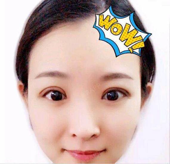 看看我做完双眼皮七天后的我,是不是就是不