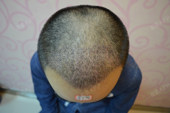 郑州欧兰植发头顶加密种植第10天美丽日记-新