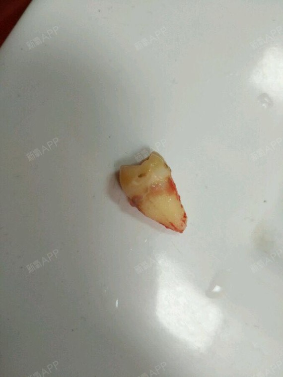 拔智齿