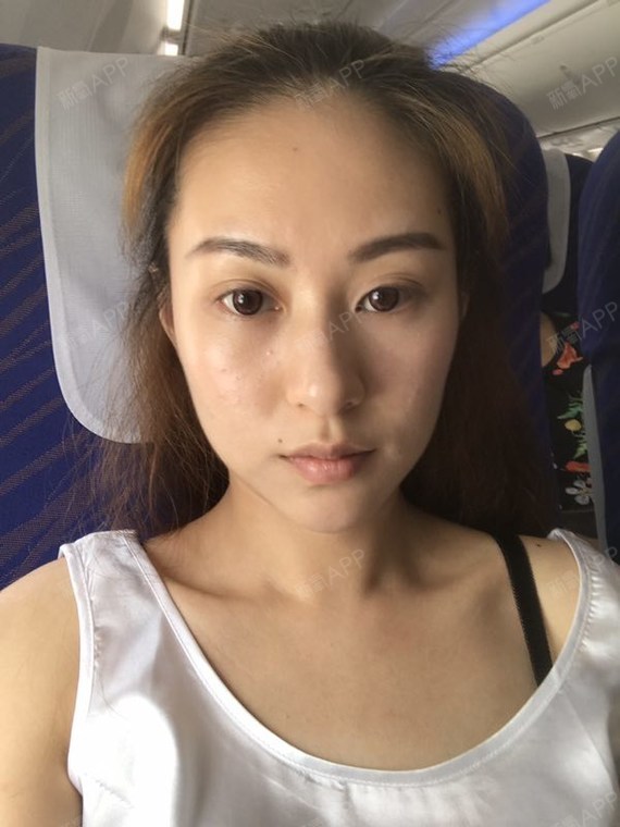 呆绵自体脂肪丰太阳穴第0天美丽日记-新氧美容