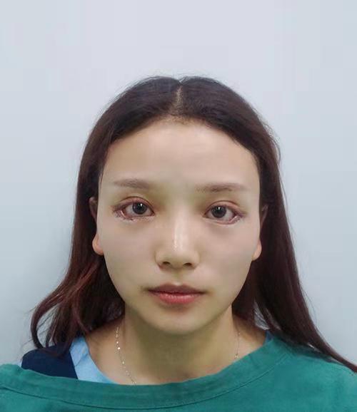 开外眼角第0天