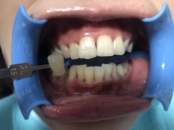 乃雯冷光美白第0天美丽日记-新氧美容整形