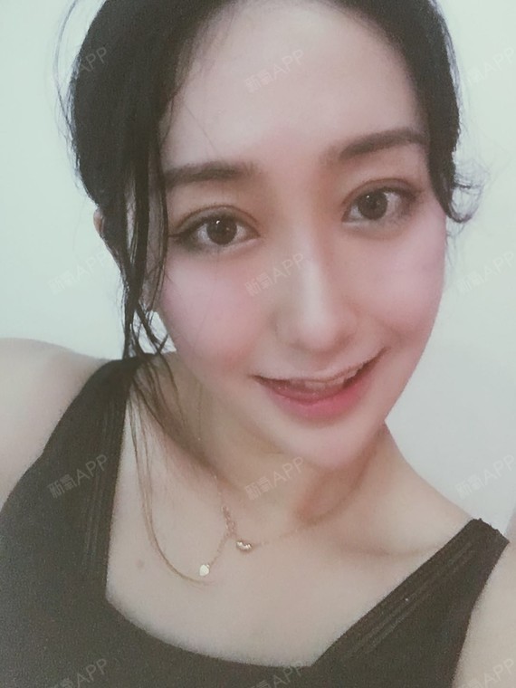 【全切双眼皮 提肌矫正 开内眼角】