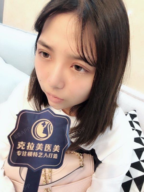 筎壹定点双眼皮第7天美丽日记-新氧美容整形