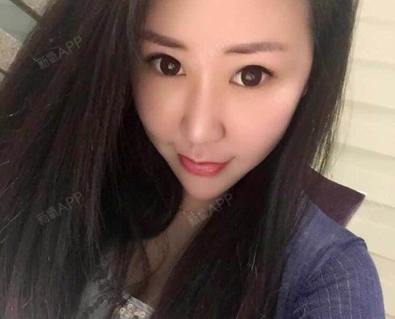 氧气x0tx6自体脂肪丰额头第7天美丽日记-新氧