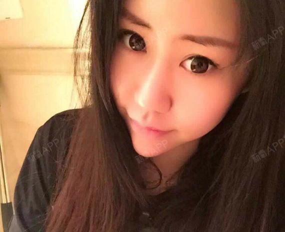 氧气x0tx6自体脂肪丰额头第7天美丽日记-新氧