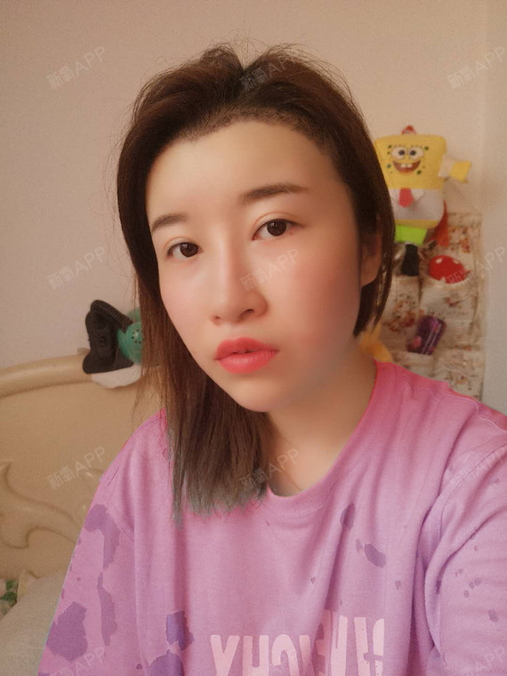 爸爸大大种植发际线第50天美丽日记-新氧美容