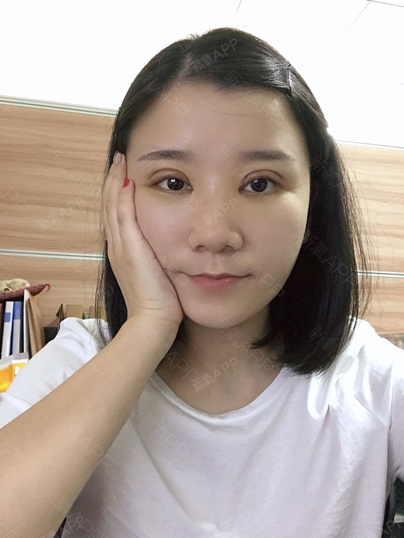 Dreamm眼部综合第3天美丽日记-新氧美容整形